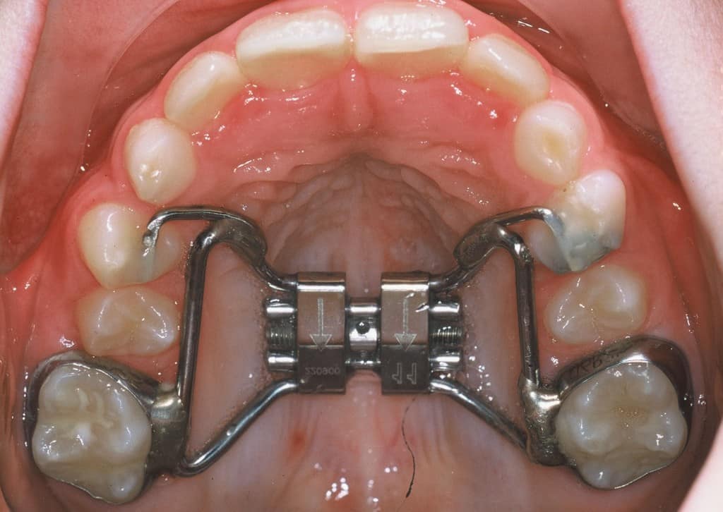 verin-orthodontie.jpg verin-orthodontie.jpg Vérin orthodontique